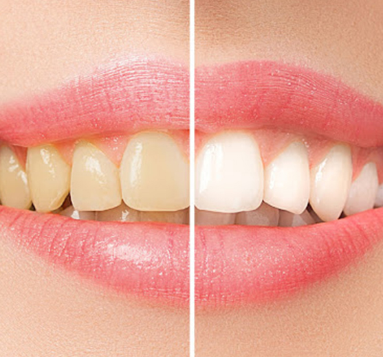 teeth-whitening