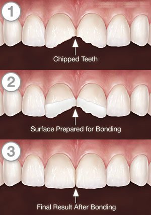 composite bonding