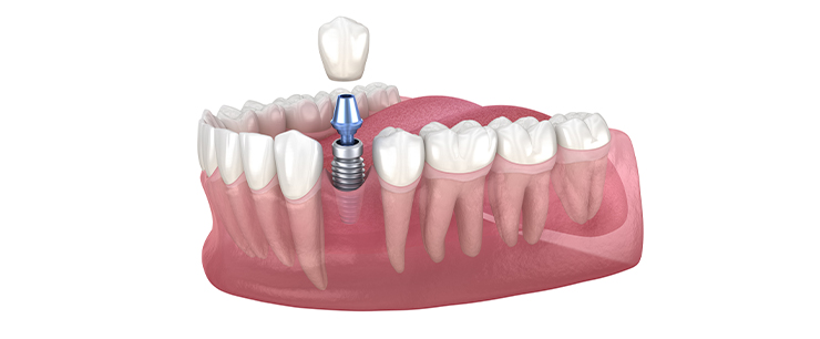 dental implant