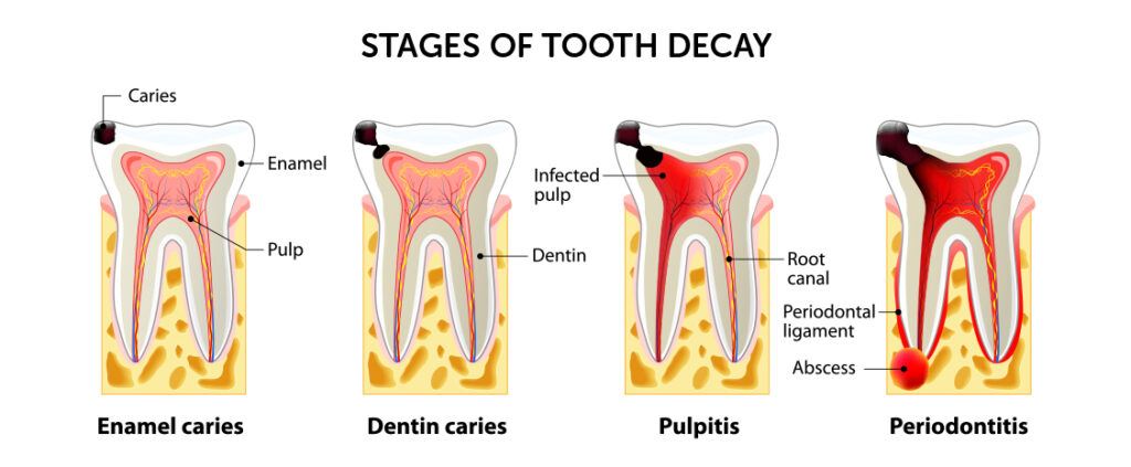 Root Canal Treatment