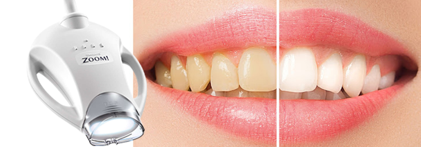 Teeth Whitening